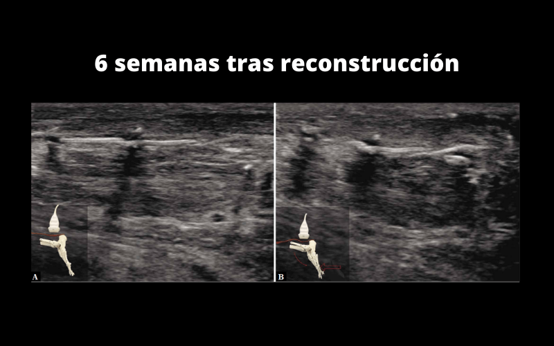 Tendón Aquiles Ecografía - Valoración Dinámica | Tempo Formación